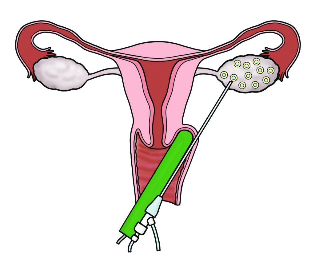 An illustration showing egg collection. Egg collection is guided with a vaginal (internal) ultrasound probe.