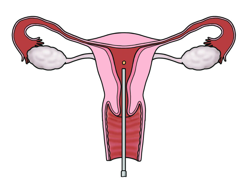Illustration showing an embryo transfer catheter releasing an embryo.