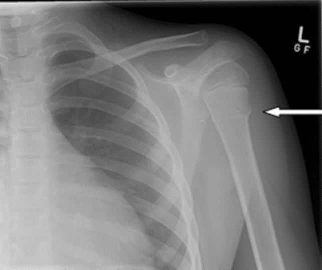 An x-ray showing a fracture in a humerus indicated with an arrow