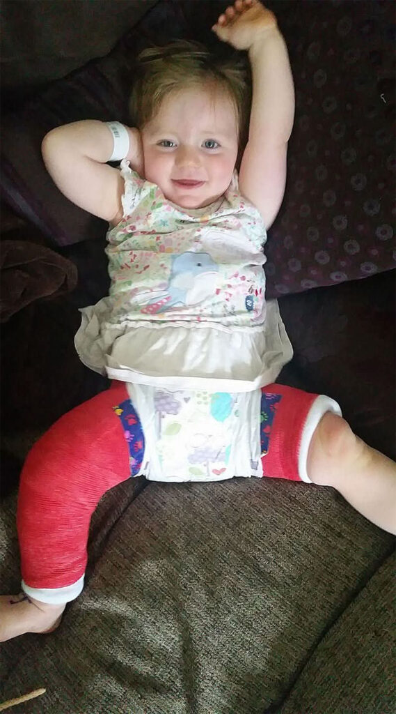 Image of Hip Spica cast in use