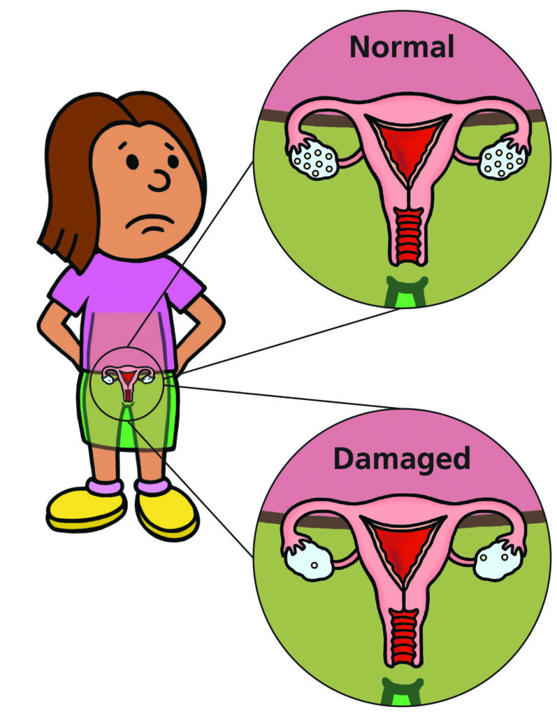 An illustration showing a young girl imagining what her ovaries look like with lots of eggs in them now and what they might look like after treatment when the number of eggs has reduced a lot.