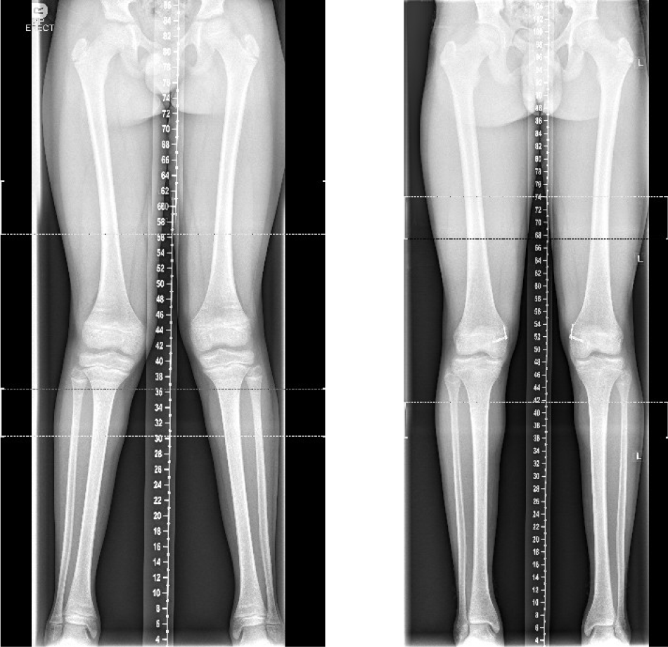X-ray images showing how the Epiphysiodesis surgical procedure is used on growing children and adolescents.