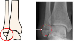 An illustration of an ankle fracture and an x-ray of the same fracture