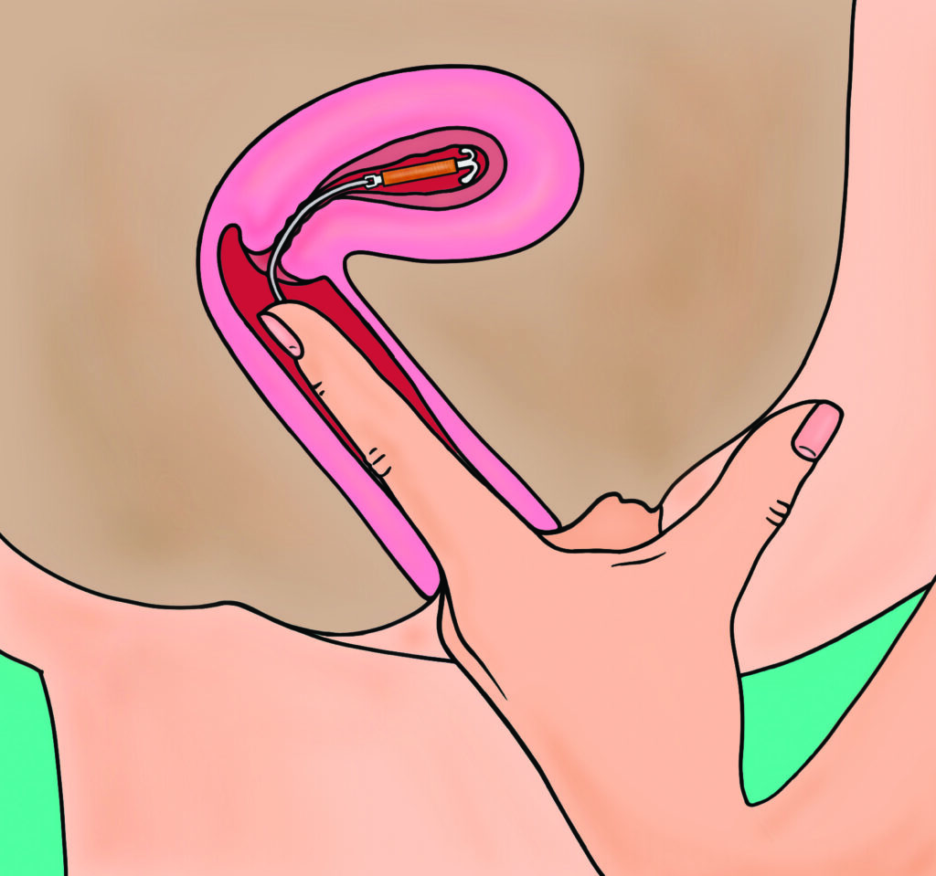 An illustration showing how to check the threads.