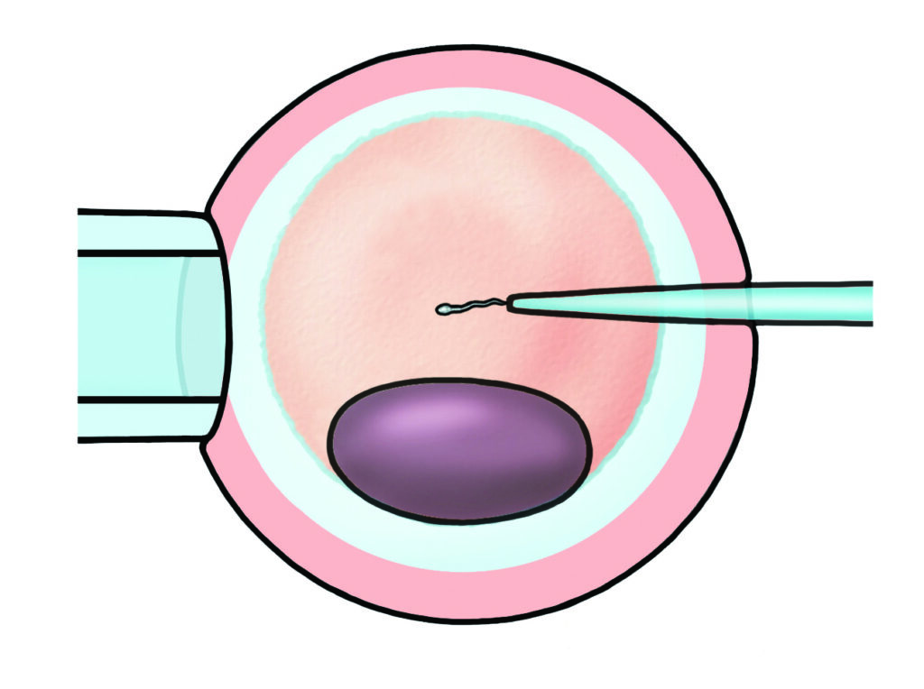 Illustration of sperm being injected into an egg.