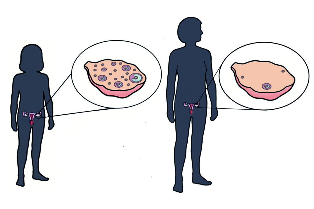 Illustration showing that the number of eggs in the ovaries is fixed at birth and reduces with age.
