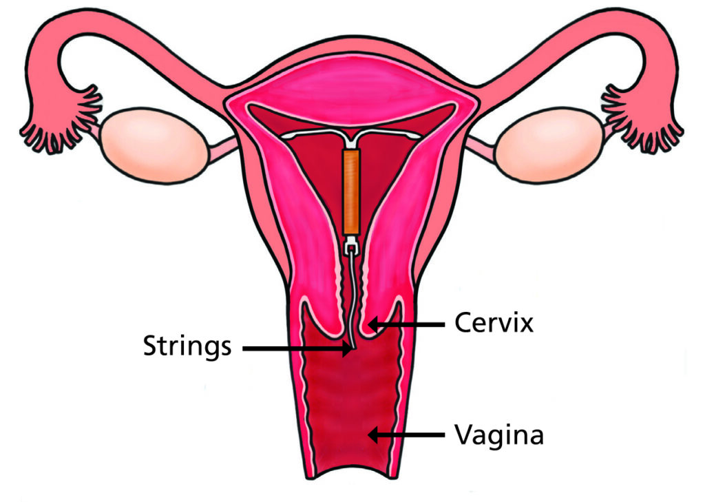 An illustration of the female reproductive system showing where coil is situated.

