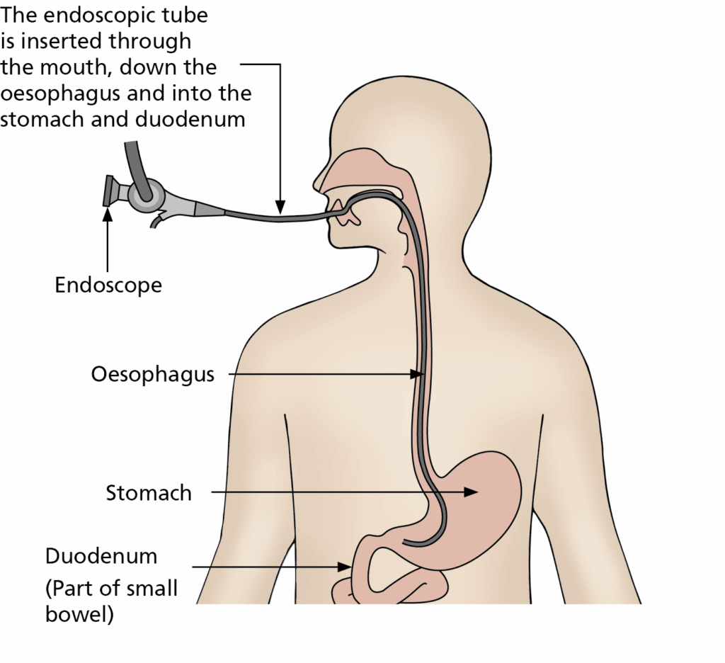 The endoscopic tube is inserted through the mouth, down the oesophagus and into the stomach and duodenum