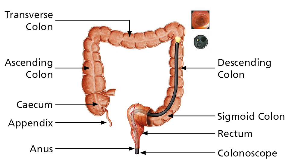 Anatomical illustration of the large intestine. The following parts are labelled: Descending Colon, Sigmoid Colon, Rectum, Anus, Appendix, Caecum, Ascending Colon, Transverse Colon.