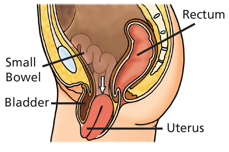 Illustration showing Uterine (Vault) prolapse