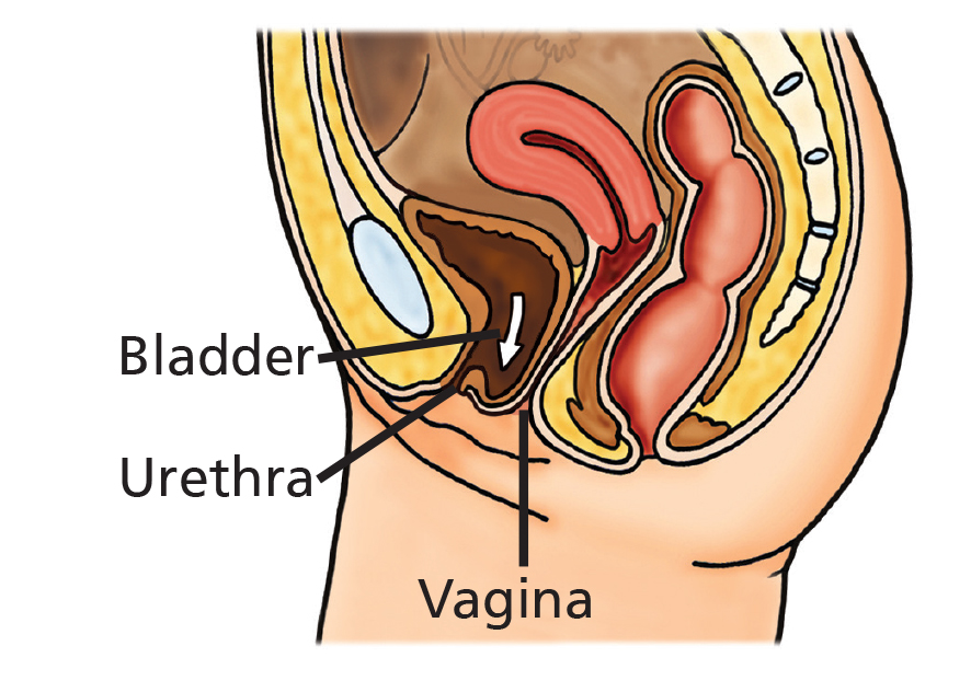 Illustration showing Front (Anterior) vaginal wall prolapse