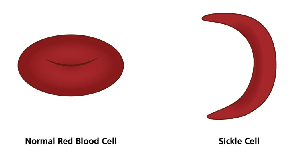 Illustration of a normal Red Blood cell and a Sickle Cell.