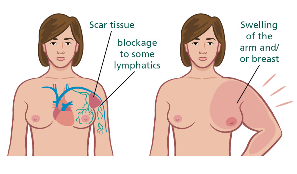 Illustration of body showing scar tissue and blockage to some lymphatics.
And an illustration showing the swelling of the arm and / or breast.