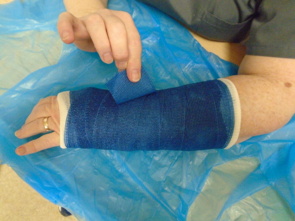 Photograph of a person holding the end of a bandage from a cast on their arm