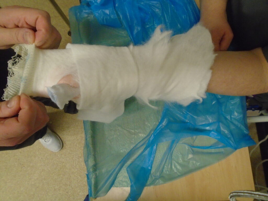 Photograph of a person pulling a wool lining from a cast on their arm