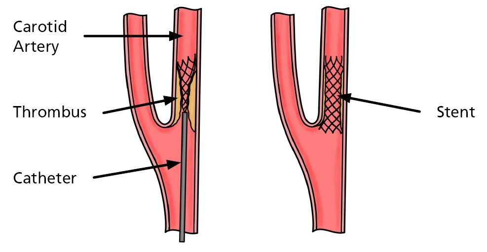 A diagram showing a stent placed in the carotid artery to open a narrowed vessel and restore blood flow to the brain.