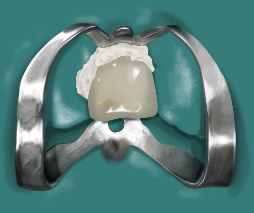 An illustration of a tooth which has been isolated from the rest of the teeth by a rubber dam.