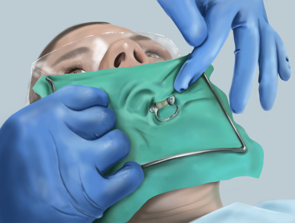 An illustration of a patient with a rubber dam placed over a tooth. The sheet covers the mouth, but leaves the nose uncovered.