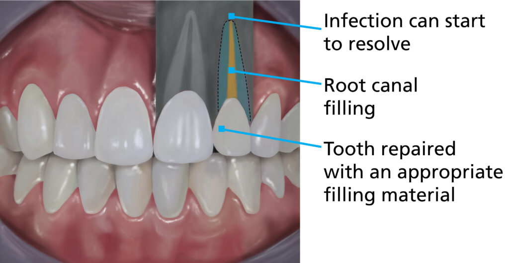 Illustration showing the same tooth after a successful root canal treatment. The infected pulp has been removed and replaced with a root canal filling. The tooth has been repaired with an appropriate filling material. The infection in the bone is shown starting to heal.