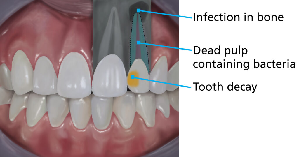 Illustration showing a front tooth with tooth decay or damage. The decay or damage has reached the inner pulp (nerve of the tooth), which causes the nerve of the tooth inside to die, and the surrounding bone to become infected. Labels point to the tooth decay/damage, the dead pulp containing bacteria, and the infection spreading into the bone.