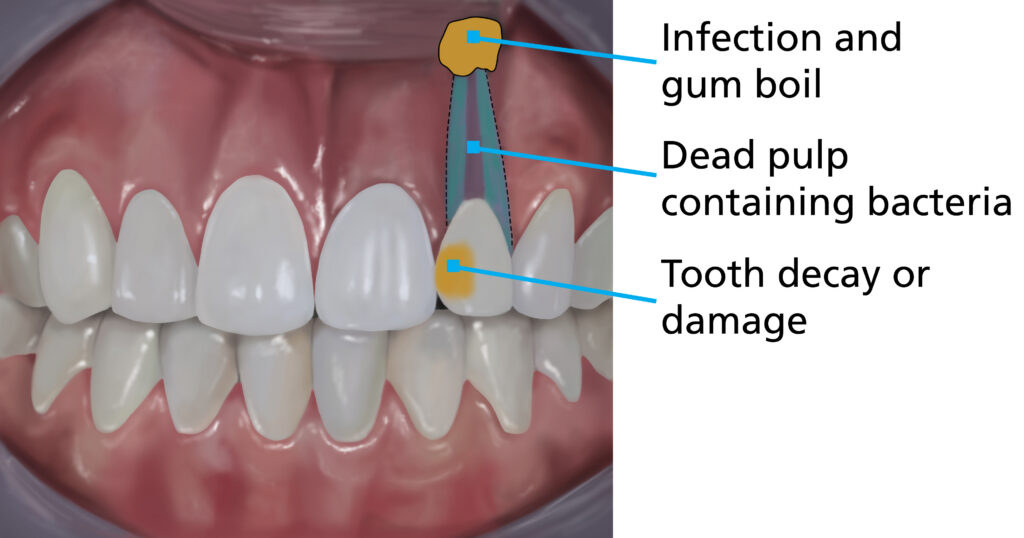 Illustration showing a tooth with severe decay/damage and an abscess which has not undergone root canal treatment. Labels highlight the tooth decay/damage, dead pulp containing bacteria, and an infection that has spread to the gum, forming a gum boil.