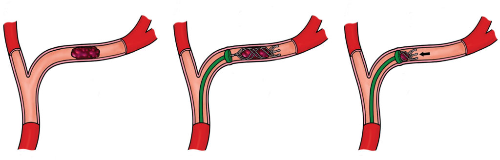 3 illustrations:



Illustration 1 (Image on the left): A cross-section of an artery showing a dark red blood clot lodged inside, blocking blood flow. The artery walls are intact, and the surrounding tissue is shaded to indicate restricted circulation.



Illustration 2 (Image in the centre): A catheter is inserted into the artery, reaching the site of the clot. A stent retriever is deployed through the catheter, expanding within the clot to capture it. The artery remains partially blocked, with the device in place.



Illustration 3 (Image on the right): The stent retriever is withdrawn along with the clot, clearing the artery. Blood flow is visibly restored, with the artery lumen open and unobstructed. The catheter is still partially visible, exiting the artery.