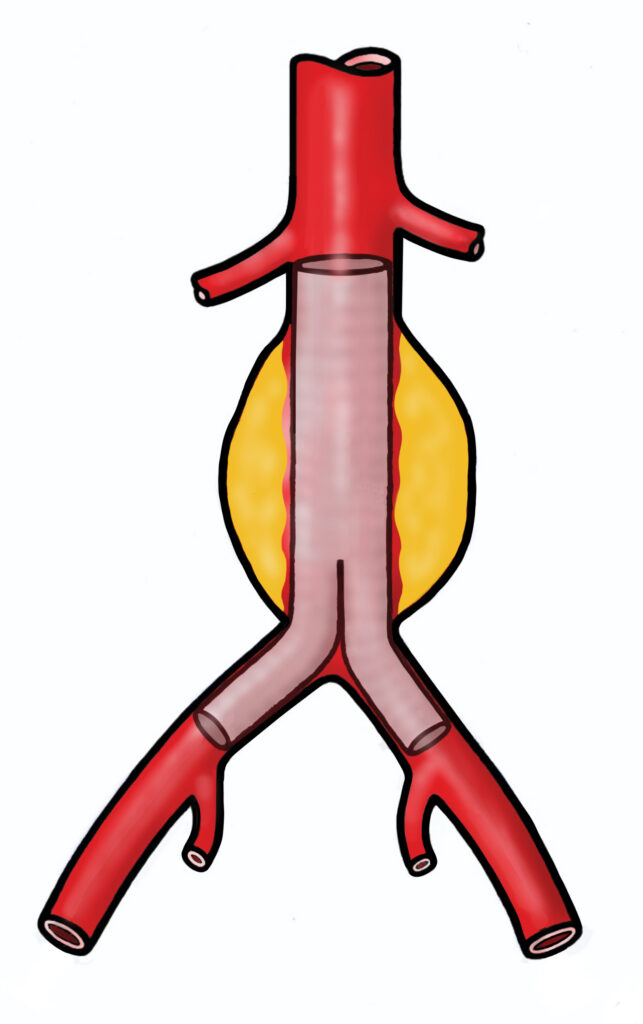 Diagram of a abnormal aorta that has been relined to exclude the bulging section from the circulation.