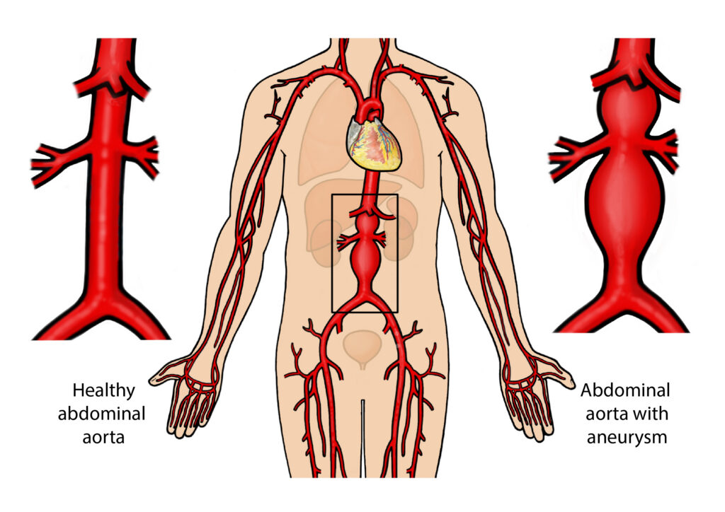 Diagram of the human arterial system highlighting the abdominal aorta, with a comparison of a normal aorta and one with a bulging aneurysm.