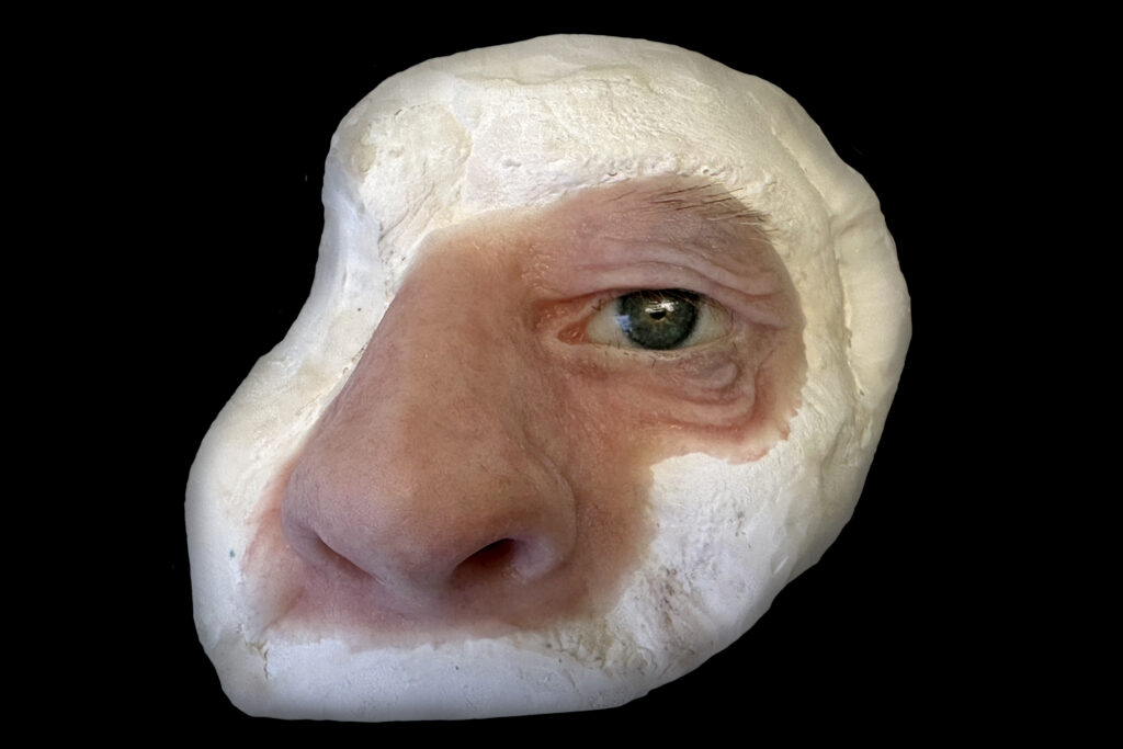Facial prosthesis - A custom-made prosthesis used to replace missing facial tissues, such as those around the eye or nose.