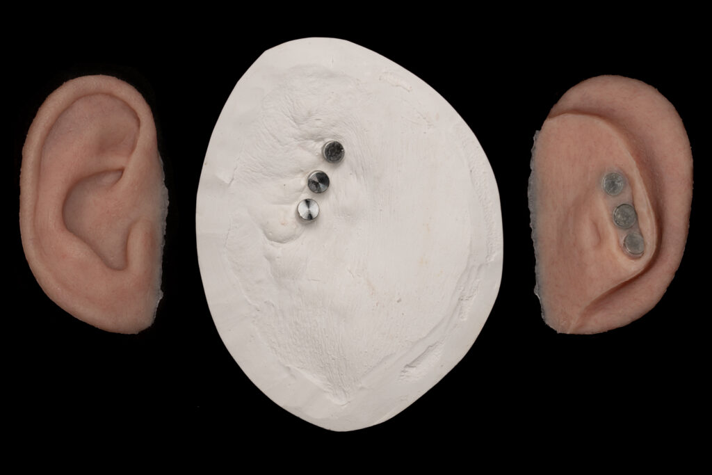 Implant-retained ear prosthesis - A custom-made artificial ear secured using small implants to provide a stable and natural-looking replacement.
