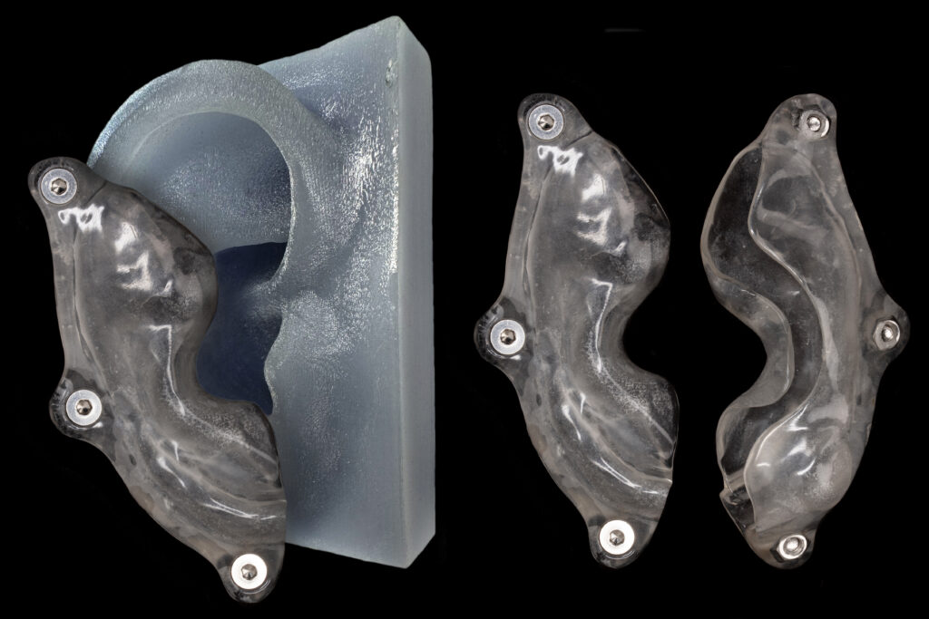Keloid splint - A custom-made appliance used to help prevent or reduce the recurrence of keloid scars after treatment.