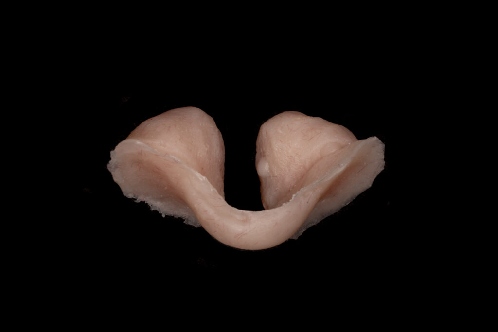 Nasal obturator - A custom-made device that helps improve speech by reducing airflow through the nose after surgery or due to certain conditions affecting the palate.