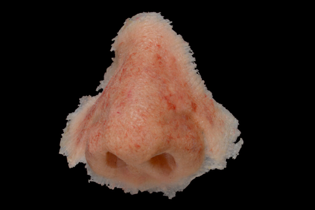Nasal prosthesis - A custom-made replacement for part or all of the nose following injury, illness, or surgery.