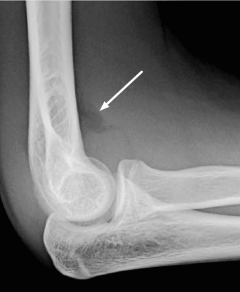 This picture shows an x-ray with an arrow pointing to the anterior fat pad sail sign.