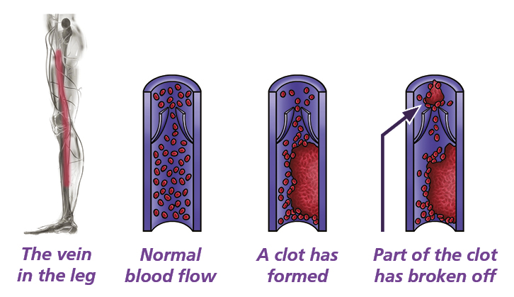 Anatomical illustration showing a vein running down the leg. Then 3 close up illustrations of a vein. The first shows normal blood flow, the second shows a blood clot forming, the third shows a part of the clot breaking off,