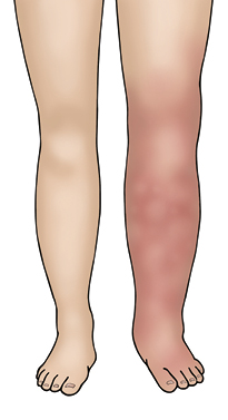 Illustration of 2 legs, one of the legs is showing symptoms of DVT, it is swollen and has discolouration.