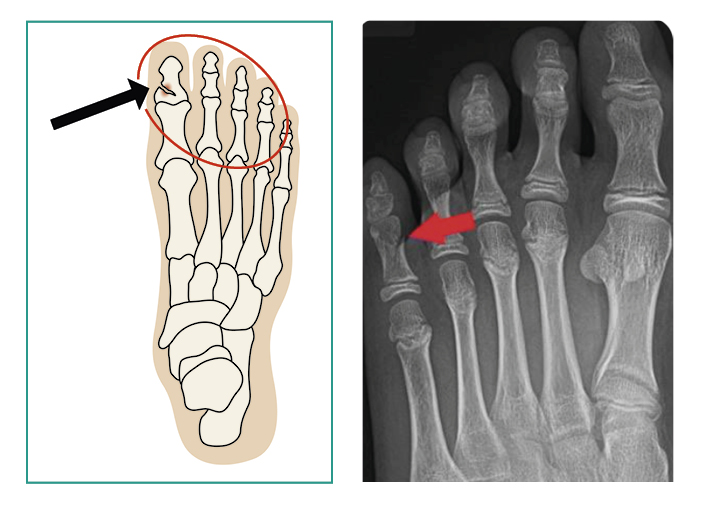 2 images: Image 1 is an illustration of the bones of the foot, there is a fracture in the big toe. Image 2 is an x-ray of the bones of the foot showing a fracture in the toe.