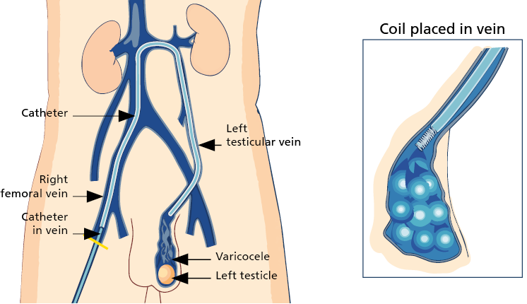 Illustration of a Testicular Vein Embolism (T V E)