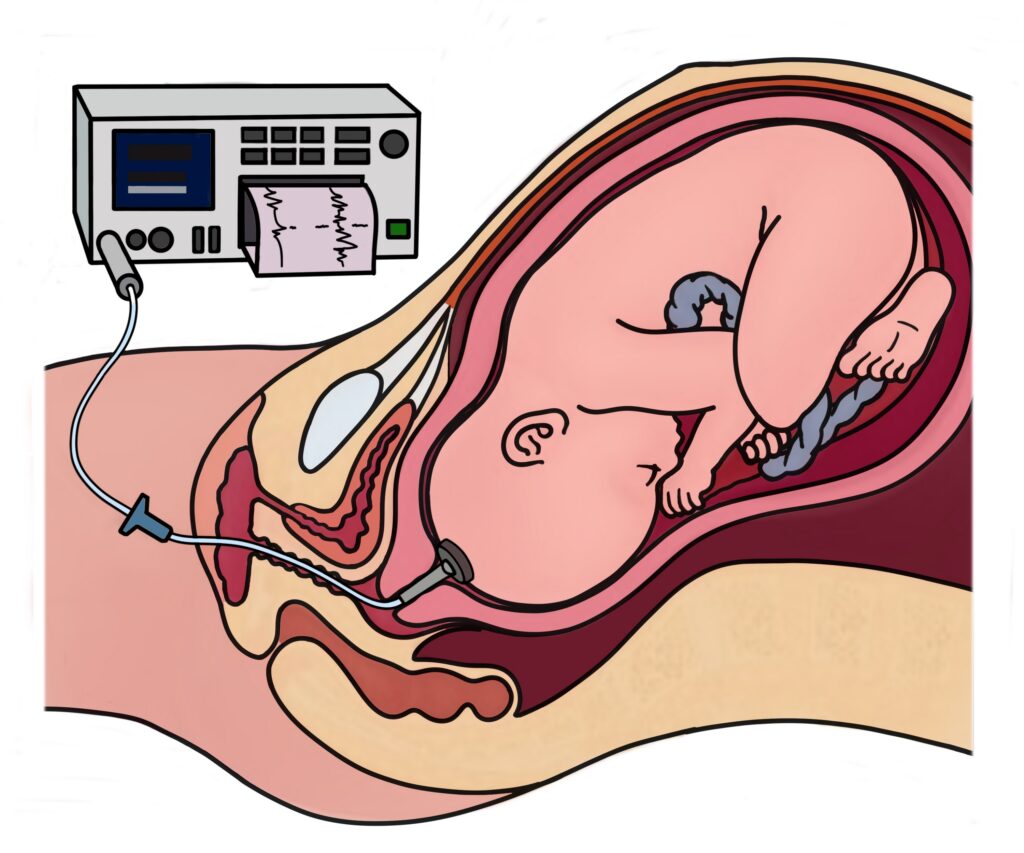 An illustration of an FSE placed just beneath the baby's scalp.