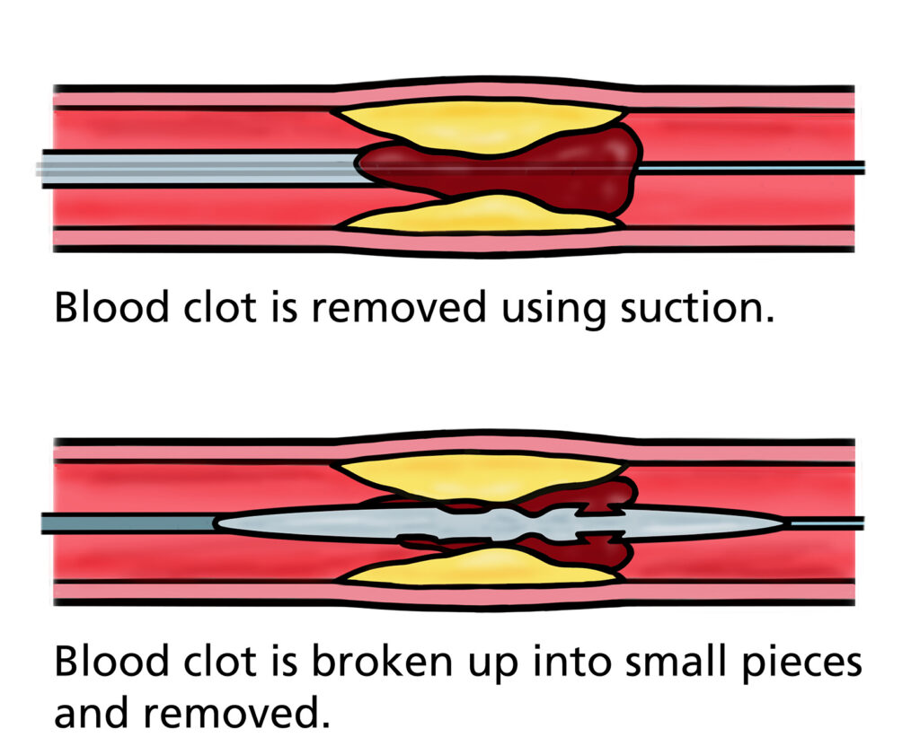 An illustration of a catheter-directed Thrombolysis showing two methods for removing a blood clot from a narrowed blood vessel. The top panel depicts a catheter using suction to extract a large clot. The bottom panel shows a device breaking the clot into smaller fragments for removal. Yellow deposits on the vessel walls indicate narrowing around the clot.