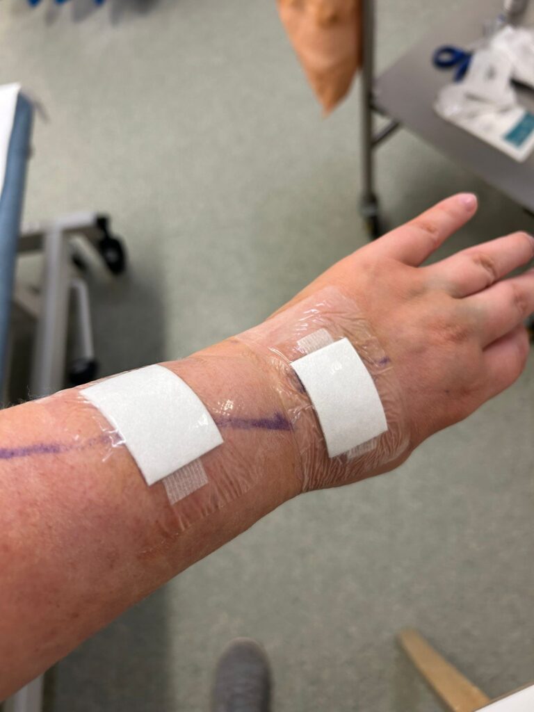 A swollen wrist with surgical pen marks and two white plasters
