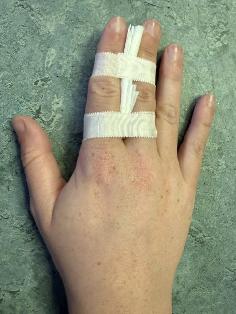 Image shows a hand with the index and middle fingers strapped together with some tape at the bottom and top of the fingers, with gauze between the fingers
