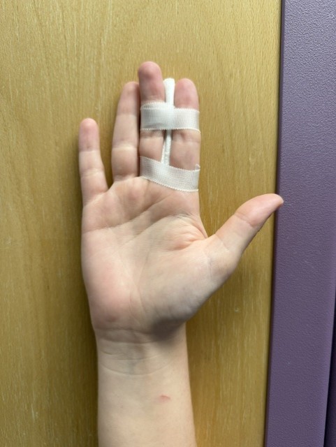 Image shows the back of someone's hand with the index and middle fingers strapped together -0 in a straight position