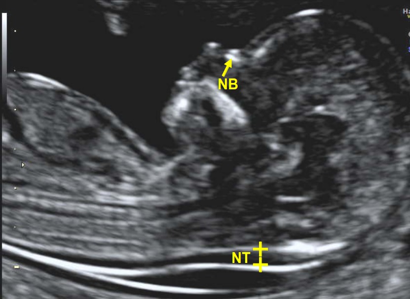 Picture showing NT (nuchal translucency) measurement on scan. 
(NB = nasal bone)