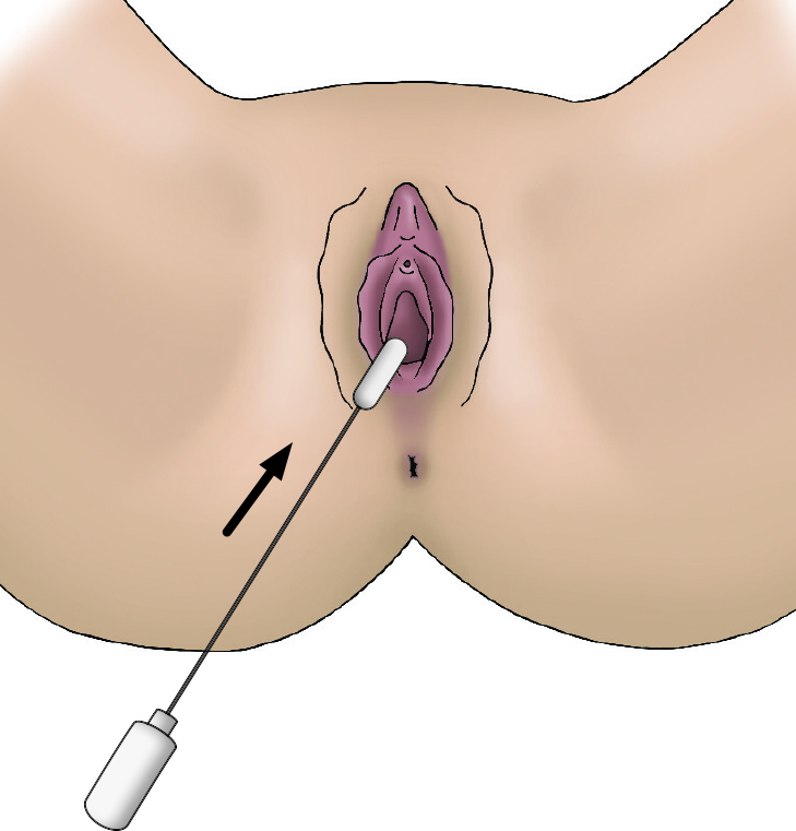 1. Illustration of vagina and anus. With the cotton end of the self-swab being inserted 2cm into the vagina.