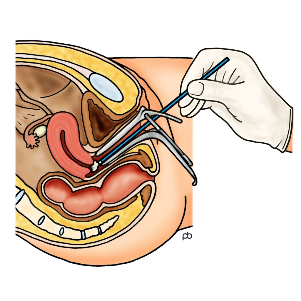 An image showing a speculum inserted into the vagina allowing a swab test to be taken from the upper vagina.