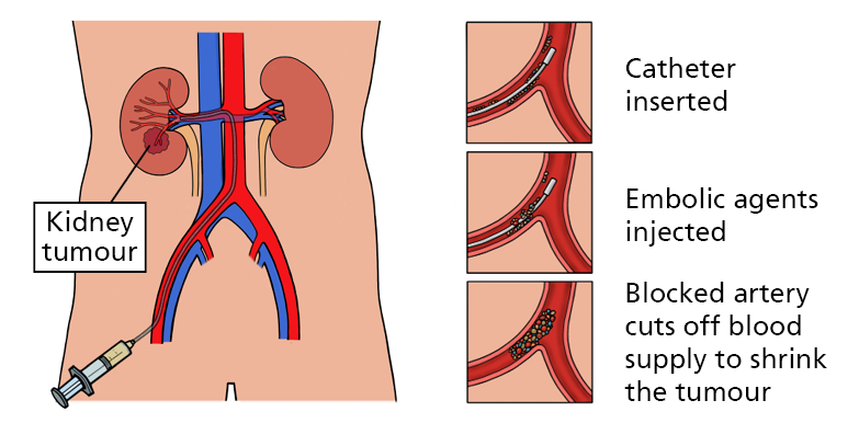 Illustration showing a kidney tumour with a close up of an inserted catheter, embolic agents being injected, and the blocked artery cutting off blood supply to shrink the tumour.