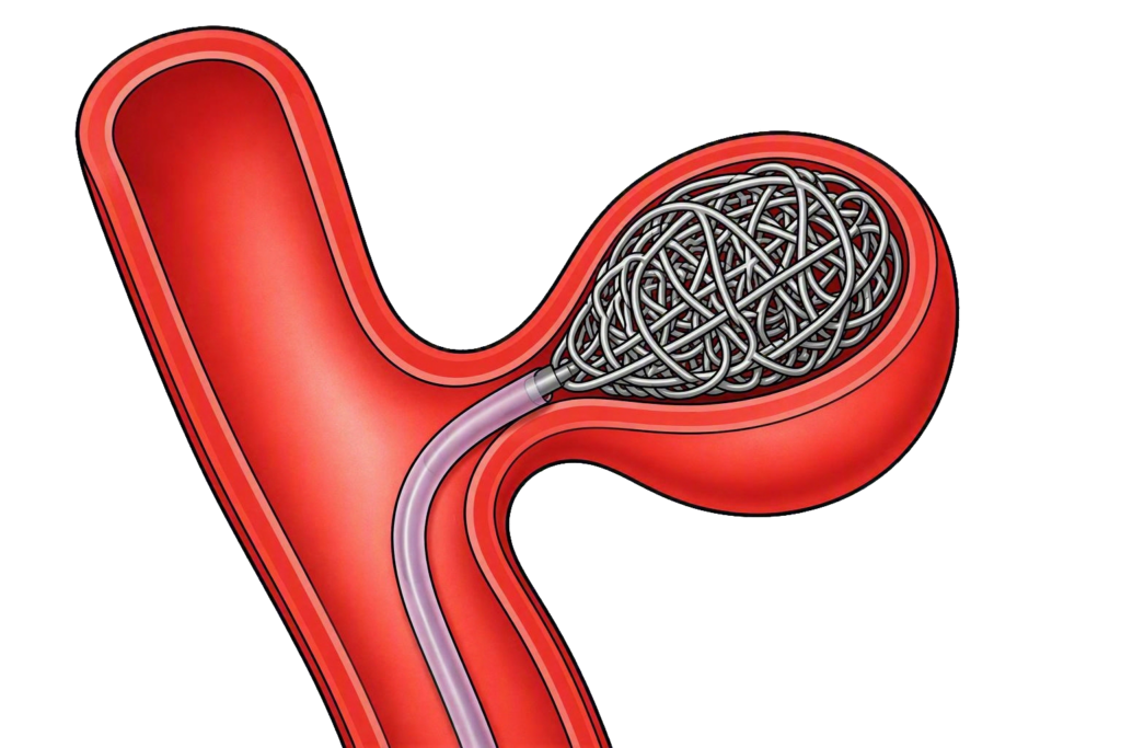An illustration showing a coiling procedure.