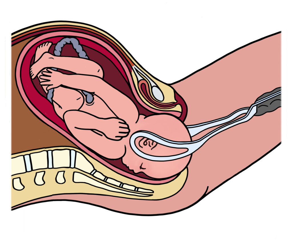 Illustration of how forceps are used.
