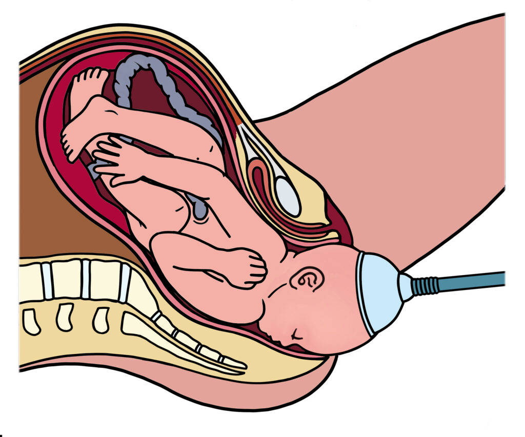 Illustration of how a ventouse is used.